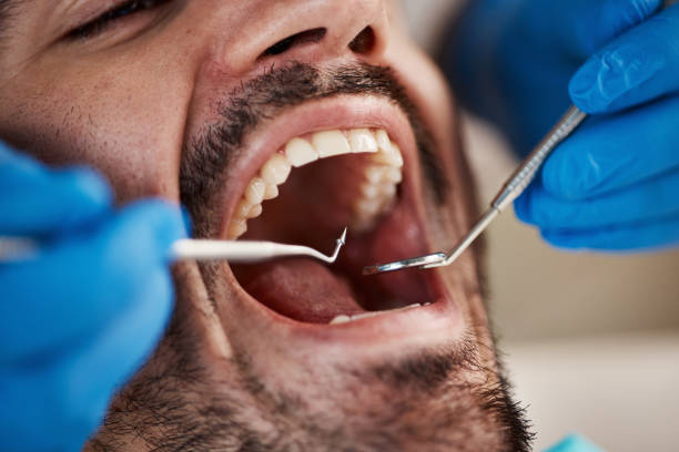 Best Emergency Tooth Extraction in Columbia, TN